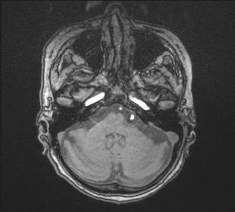 【頭部】症例26 頚部MRI（MRA元画像）