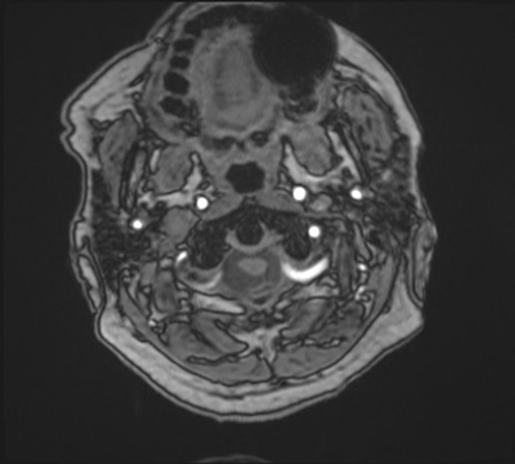 【頭部】症例27 頚部MRI（MRA元画像）