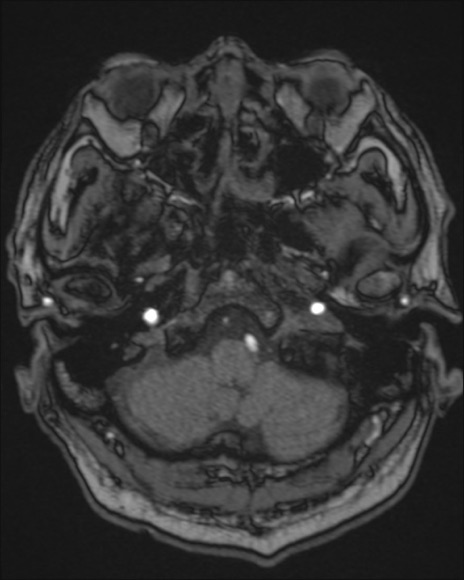 【頭部】症例31 MRI（MRA元画像）