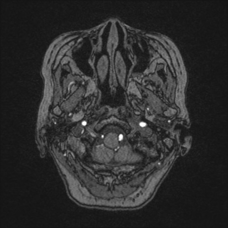 【頭部】症例33 MRI（MRA元画像）