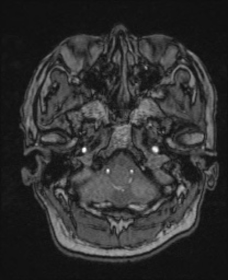 【頭部】症例53 MRI（MRA元画像）