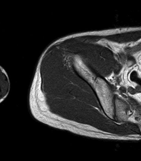 薄筋(gracilis muscle)のMRI画像の解剖