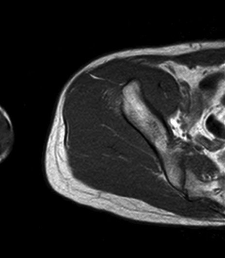 薄筋(gracilis muscle)のMRI画像の解剖