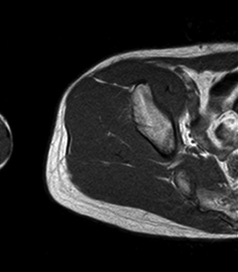 薄筋(gracilis muscle)のMRI画像の解剖