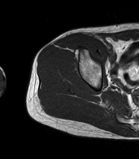 薄筋(gracilis muscle)のMRI画像の解剖