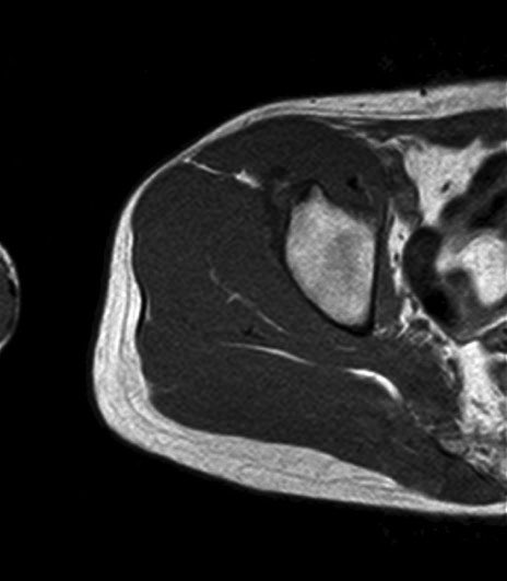 薄筋(gracilis muscle)のMRI画像の解剖