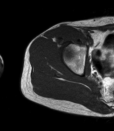 薄筋(gracilis muscle)のMRI画像の解剖